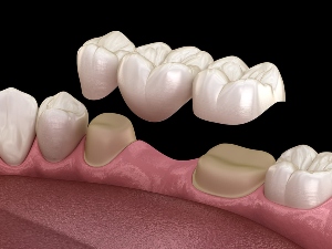 dental-bridge-vs-dental-implant